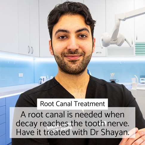 Root canal with Dr Shayan in London