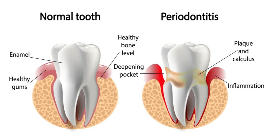 Periodontal Disease 