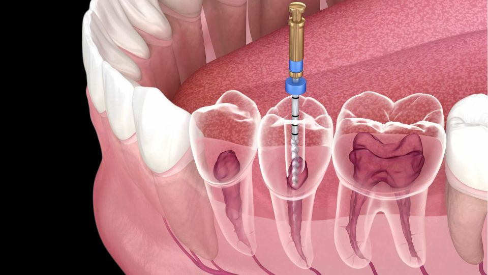 Root canal treatment on a single tooth