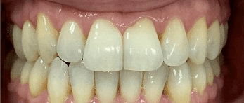 Fixed Metal Braces After Treatment – Improved Front Tooth Alignment After fixed metal braces treatment showing improved front tooth alignment at Whites Dental Marble Arch