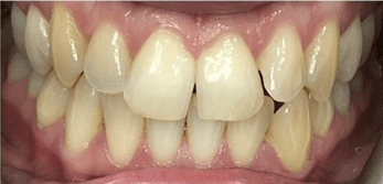 Fixed Metal Braces Before Treatment – Front Tooth Crowding Before fixed metal braces treatment showing front tooth crowding at Whites Dental Marble Arch