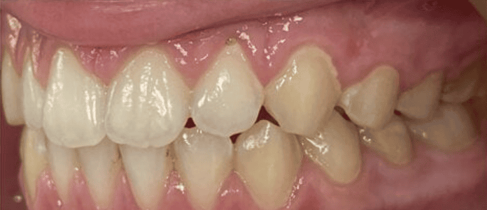 Ceramic Fixed Braces After Treatment – Large Upper Front Tooth Gap Closed After ceramic fixed braces treatment showing closure of a large upper front tooth gap at Whites Dental Marble Arch