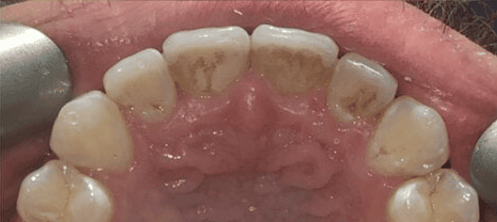 After ceramic fixed braces treatment showing improved upper front tooth alignment at Whites Dental Marble Arch