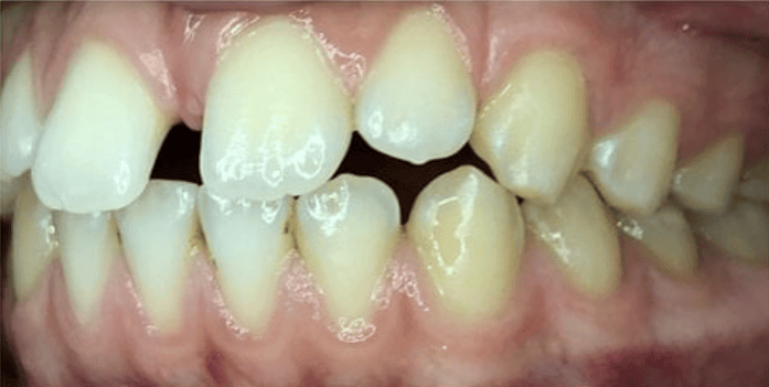 Ceramic Fixed Braces Before Treatment – Large Upper Front Tooth Gap Before ceramic fixed braces treatment showing a large gap between the upper front teeth at Whites Dental Marble Arch