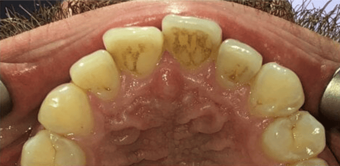 Before ceramic fixed braces treatment showing rotated upper front teeth at Whites Dental Marble Arch