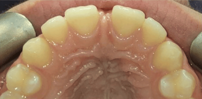Before ceramic fixed braces treatment showing upper arch crowding at Whites Dental Marble Arch