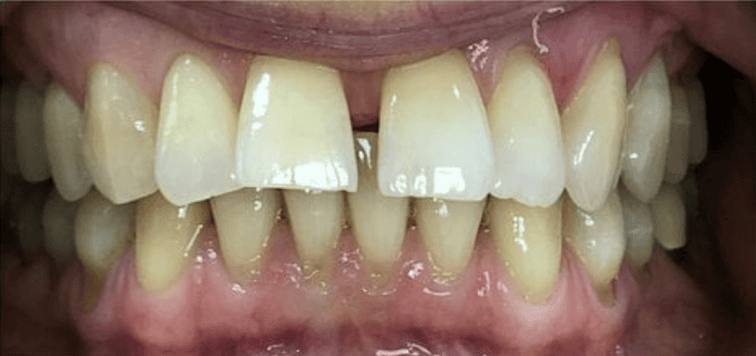 Ceramic Fixed Braces Before Treatment – Front Tooth Crowding Before ceramic fixed braces treatment showing front tooth crowding at Whites Dental Marble Arch