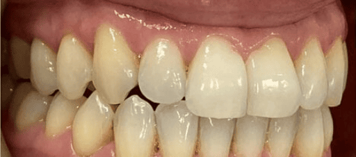 After fixed metal braces treatment showing improved overjet and tooth alignment at Whites Dental Marble Arch
