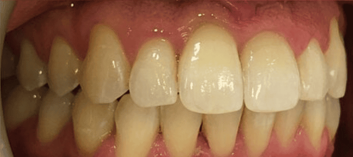 Fixed Metal Braces After Treatment – Improved Side Bite Alignment After fixed metal braces treatment showing improved side bite alignment at Whites Dental Marble Arch
