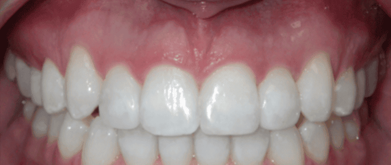After fixed metal braces treatment showing improved front tooth alignment at Whites Dental Marble Arch