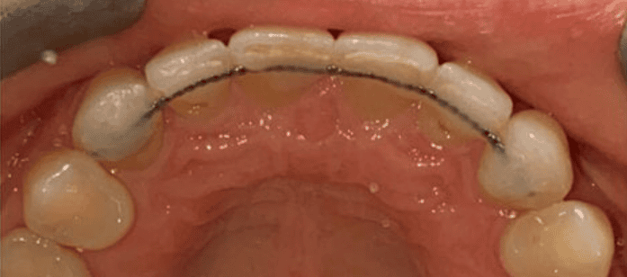 Fixed Metal Braces After Treatment – Upper Front Tooth Alignment With Retainer After fixed metal braces treatment showing improved upper front tooth alignment and fixed retainer at Whites Dental Marble Arch