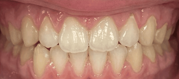 Fixed Metal Braces After Treatment – Closed Front Tooth Gaps And Improved Bite After fixed metal braces treatment showing closed front tooth gaps and improved bite alignment at Whites Dental Marble Arch