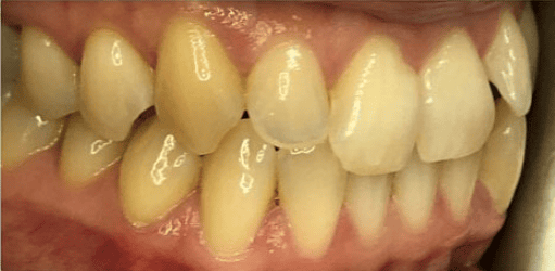 Before fixed metal braces treatment showing increased overjet at Whites Dental Marble Arch