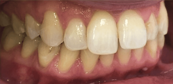 Fixed Metal Braces Before Treatment – Side Bite Alignment Before fixed metal braces treatment showing uneven side bite alignment at Whites Dental Marble Arch