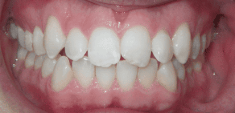Before fixed metal braces treatment showing uneven front teeth at Whites Dental Marble Arch