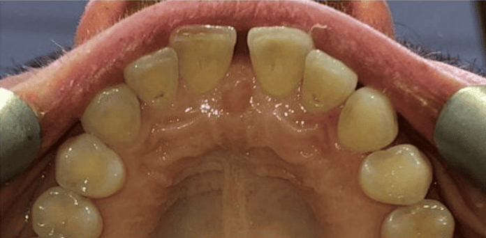 Fixed Metal Braces Before Treatment – Upper Front Tooth Crowding Before fixed metal braces treatment showing upper front tooth crowding at Whites Dental Marble Arch