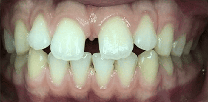 Fixed Metal Braces Before Treatment – Front Tooth Gaps And Bite Alignment Before fixed metal braces treatment showing front tooth gaps and uneven bite alignment at Whites Dental Marble Arch