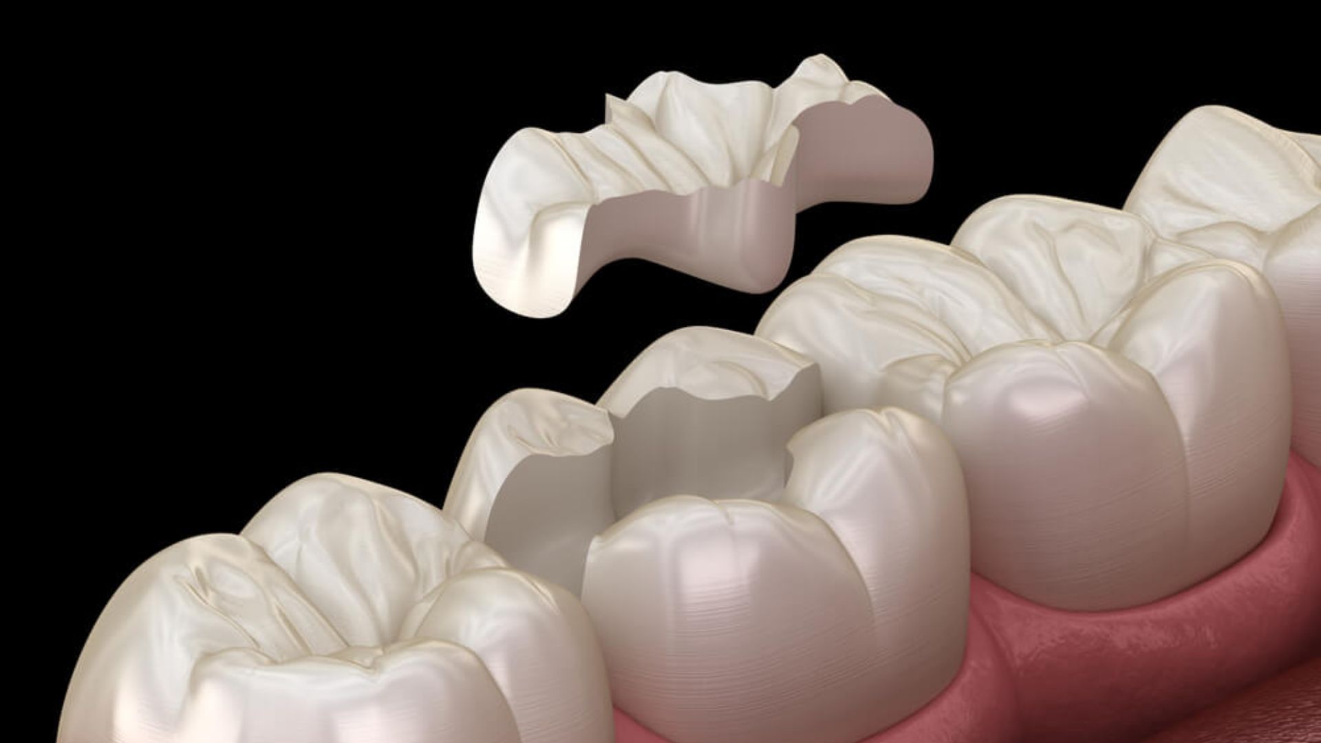 Broken Lost Filling Repair - Treatments At Whites Dental In London