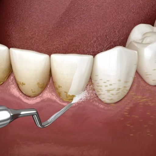 Dental Hygienist - Air Flow With Stain Removal