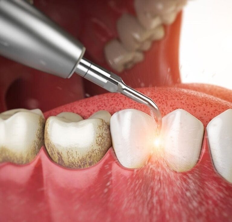 Dental Hygienist Periodontal Maintenance