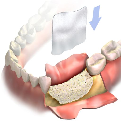 Guided Tissue Regeneration At Whites Dental In London