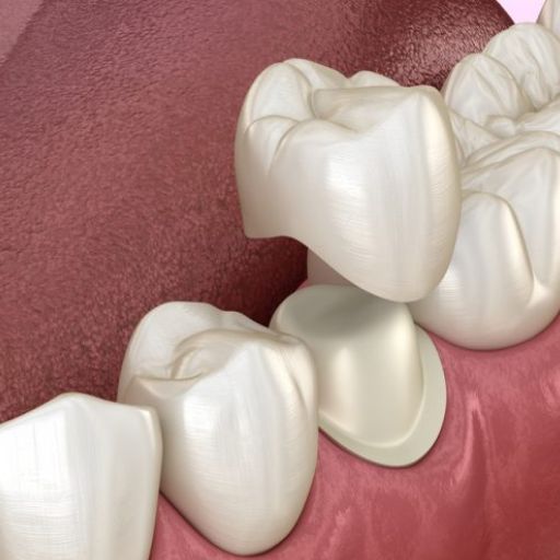 Lost Or Broken Filling Repair Treatment Option - Dental Crown
