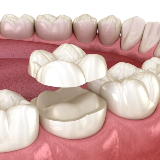 Lost Or Broken Filling Repair Treatment Option - Inlay Or Onlay