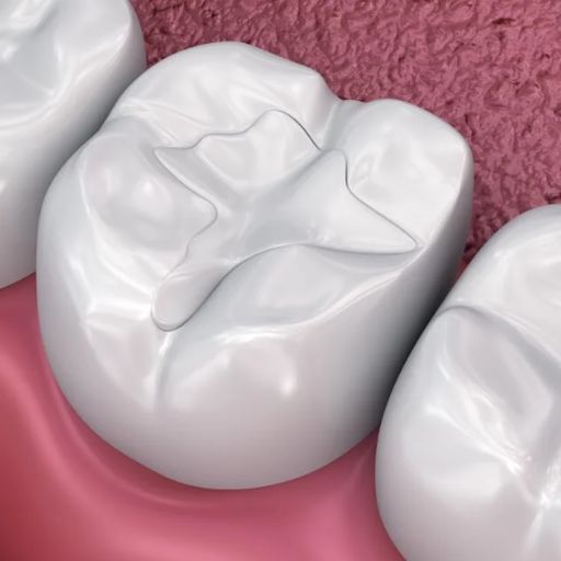 Lost Or Broken Filling Repair Treatment Option - Replacement Filling