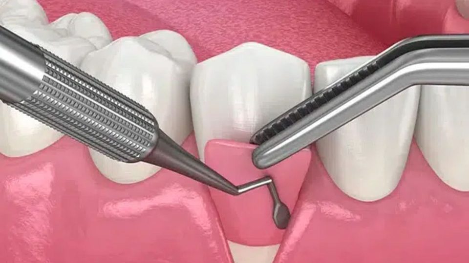 Periodontal Flap Surgery Or Pocket Reduction Surgery