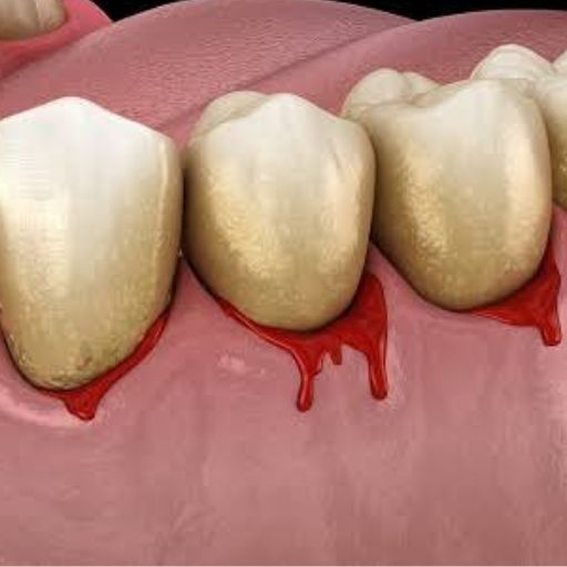 Periodontal Treatment For Bleeding, Swollen And Inflamed Gums