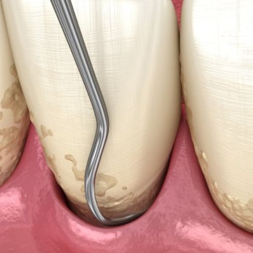 Periodontal Treatment For Gum Pockets