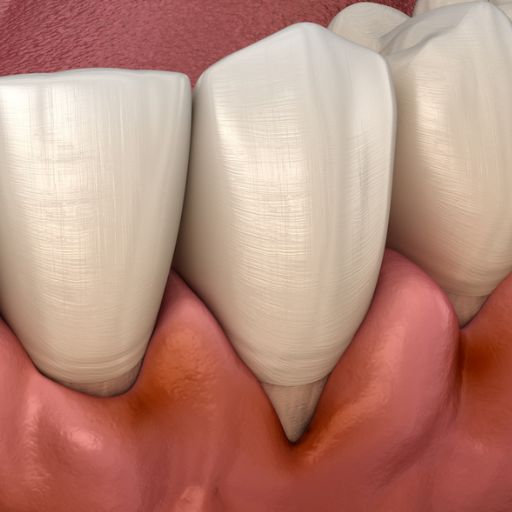 Periodontal Treatment For Loose Teeth