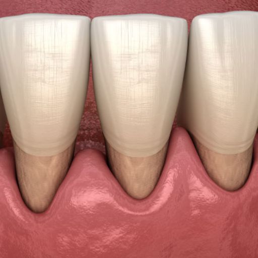 Periodontal Treatment For Receding Gums