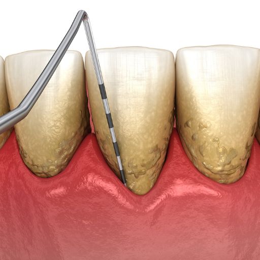 Periodontal Treatment - Maintenance