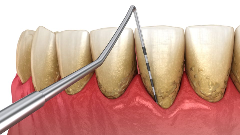 Periodontal maintenance for gum disease care