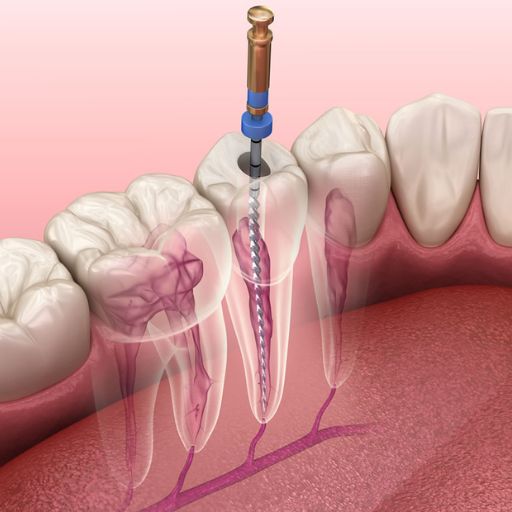Root Canal Retreatment