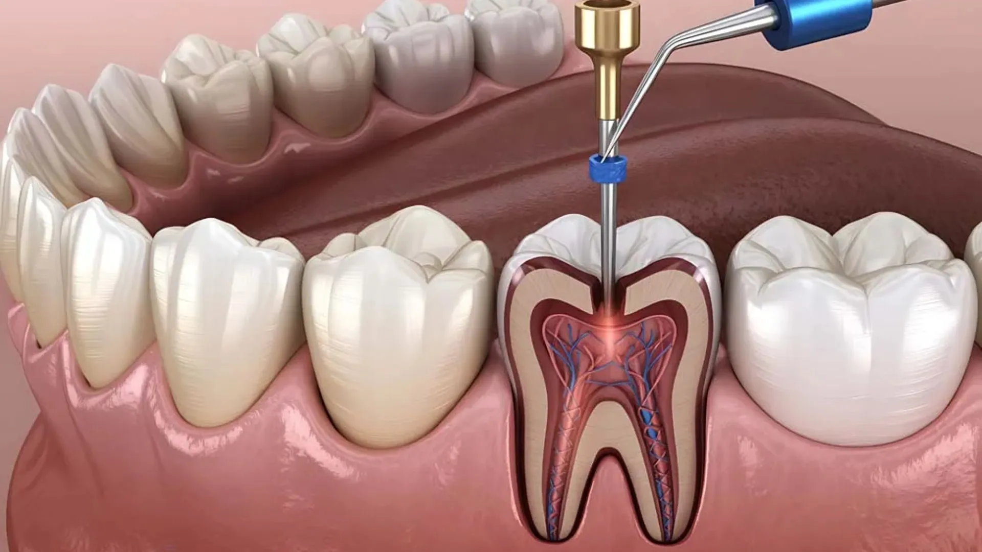 Root Canal Treatment - Whites Dental in London