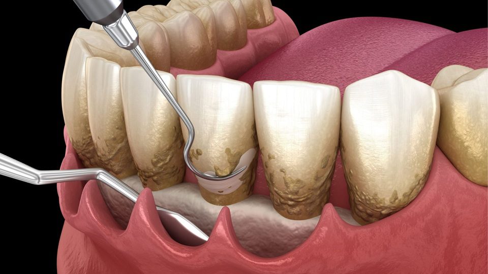 Scaling And Root Planing At Whites Dental In London