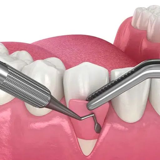 Surgical Periodontal Treatment