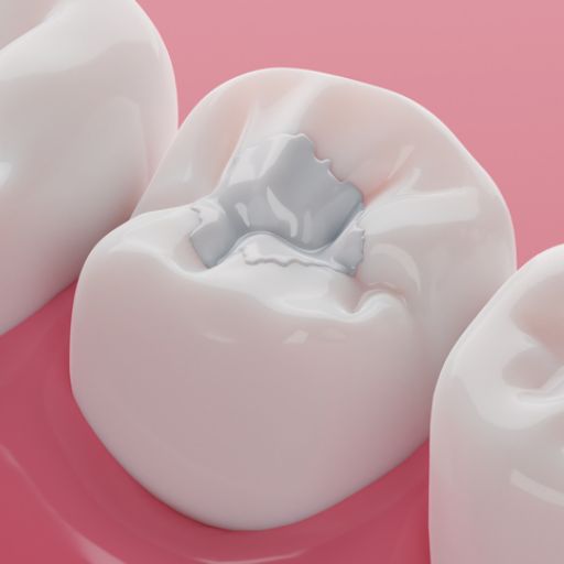 Toothache treatment - dental filling