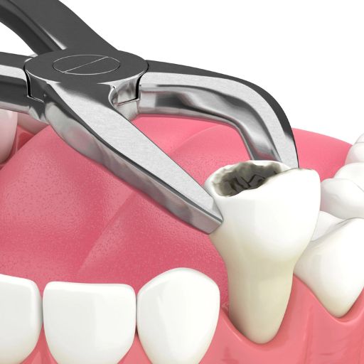 Toothache treatment - extraction