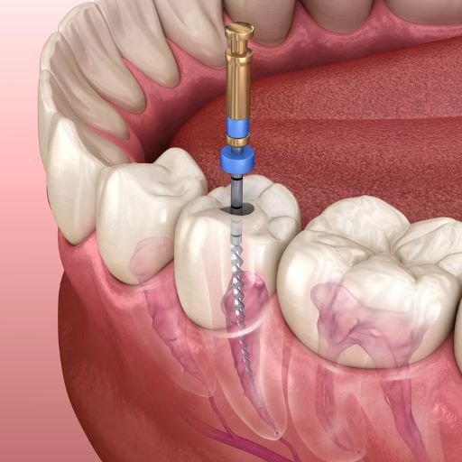 Toothache treatment - root canal