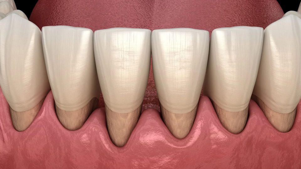 What Is Gum Recession