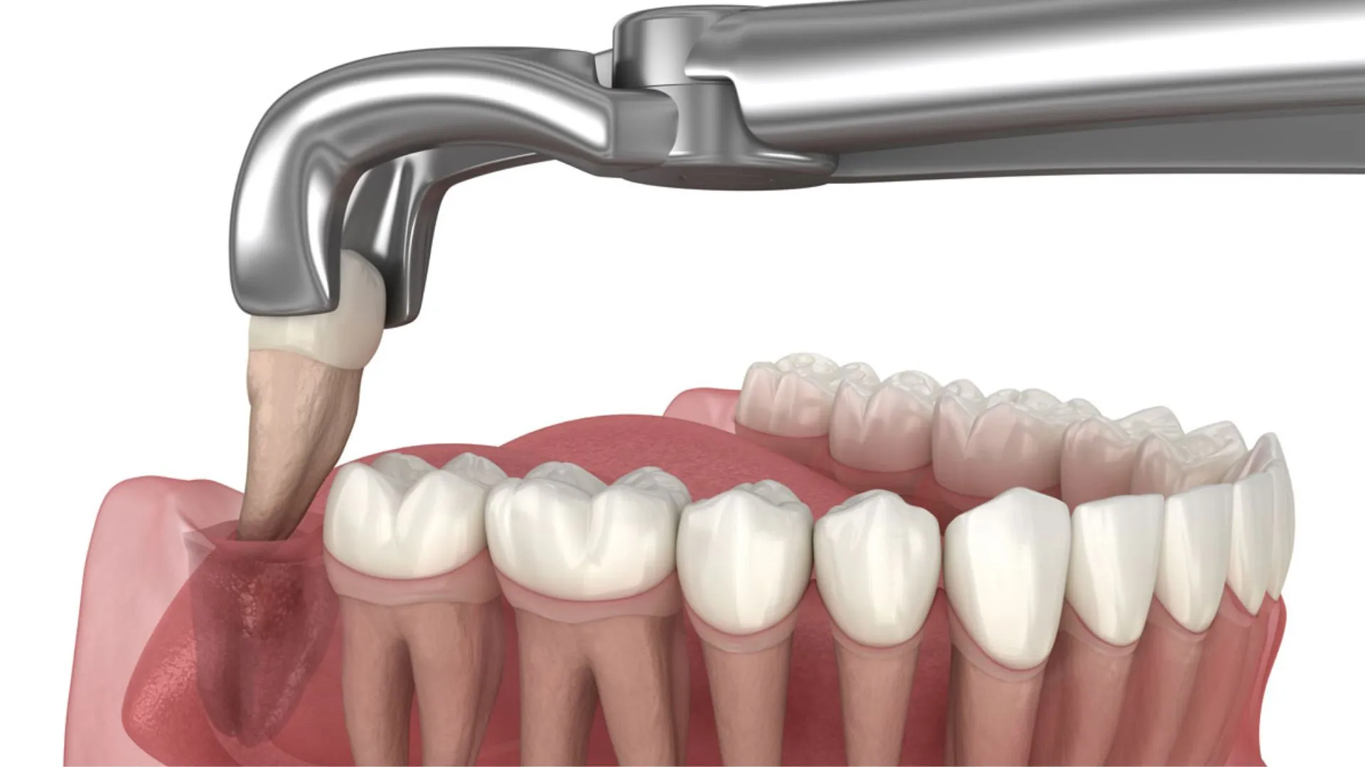 Wisdom Tooth Removal
